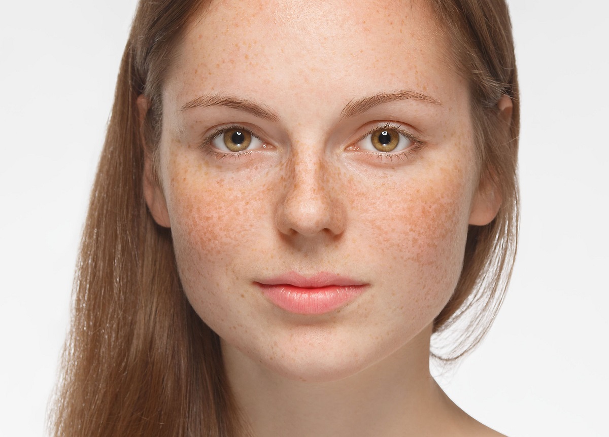 usuwanie przebarwień na twarzy